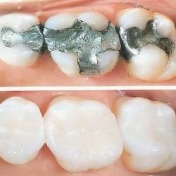Dental filling2