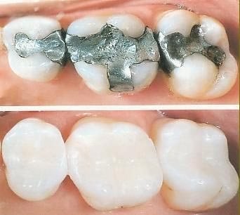 Dental filling2