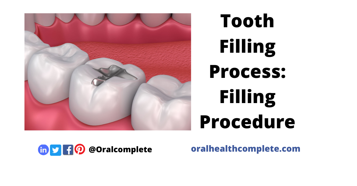 Tooth discoloration after trauma Reasons Treatments 17