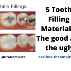 Tooth discoloration after trauma Reasons Treatments 19