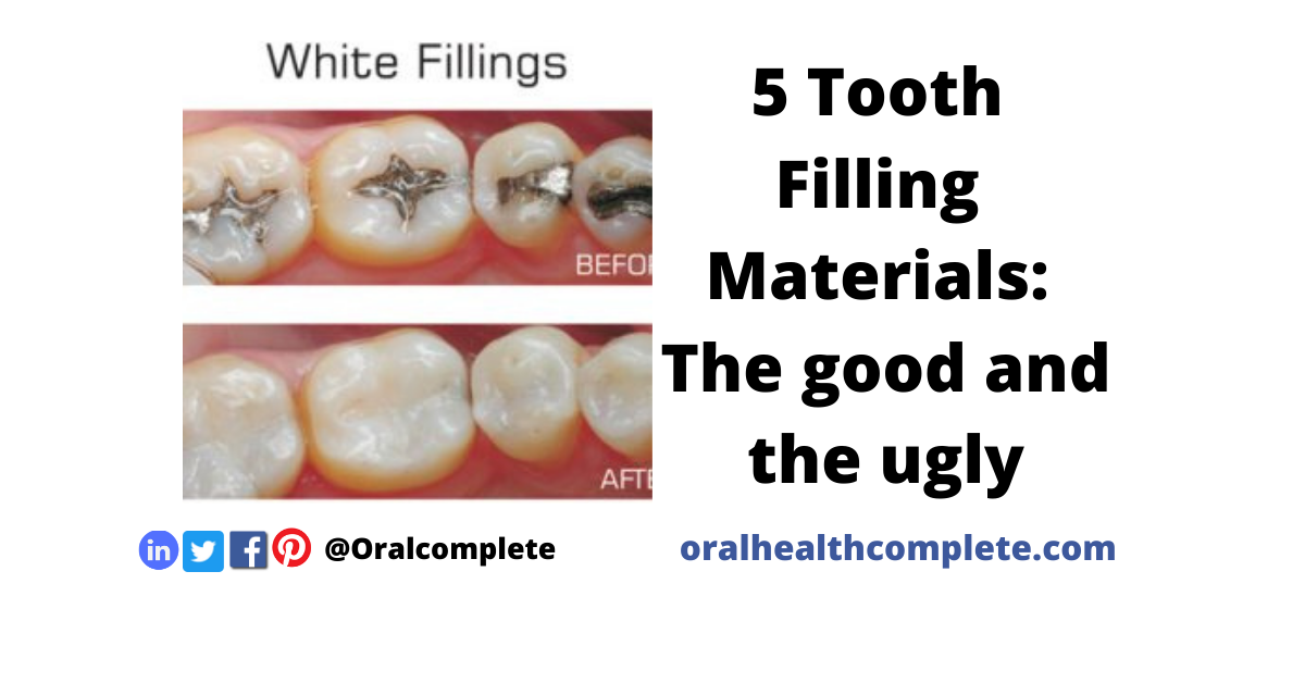 Tooth discoloration after trauma Reasons Treatments 19