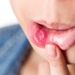 Woman with serious mouth ulcer