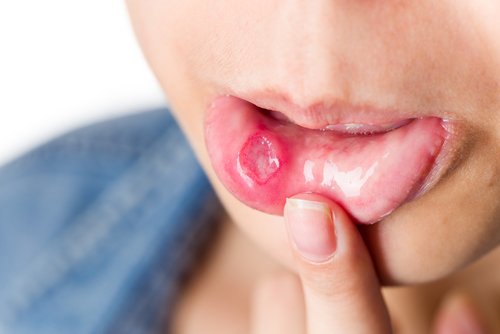 Woman with serious mouth ulcer