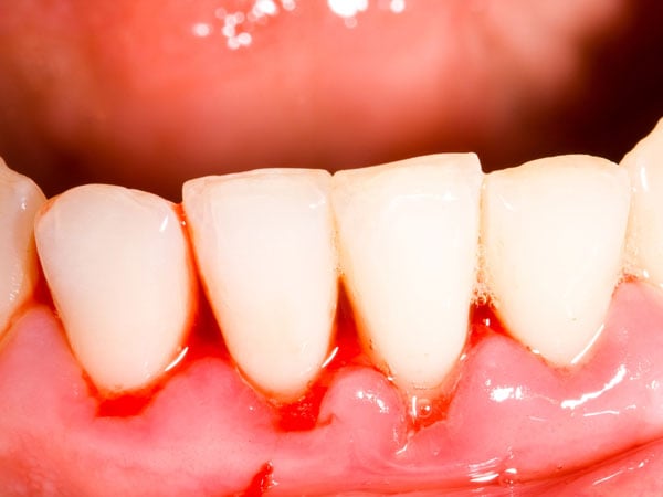 bleeding gums causes