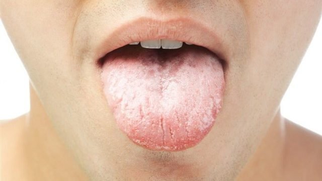 dry mouth 640x360