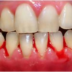 early symptoms of gingivitis