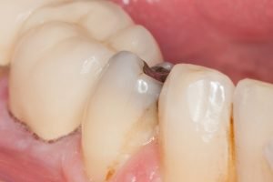 tooth decay e1544913347714