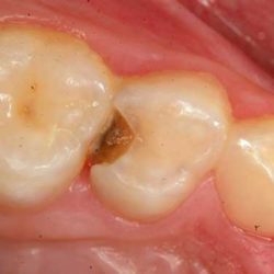 Decayed primary molar