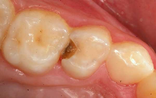 Decayed primary molar