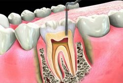 Root Canal Therapy Guntersville AL 300x169