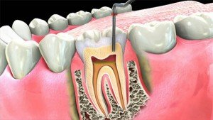 Root Canal Therapy Guntersville AL 300x169