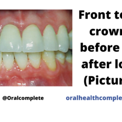 Tooth discoloration after trauma Reasons Treatments 18