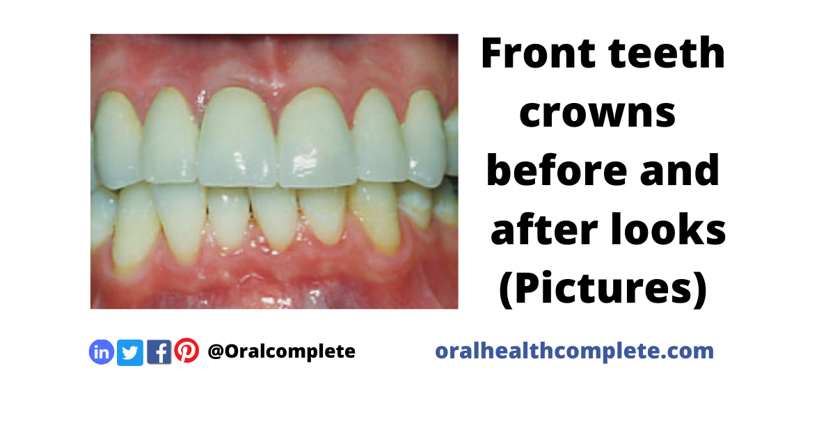 Tooth discoloration after trauma Reasons Treatments 18