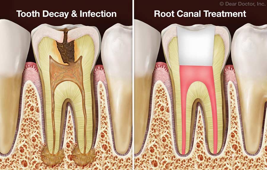 after root canal