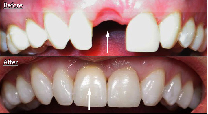 crowns on front teeth