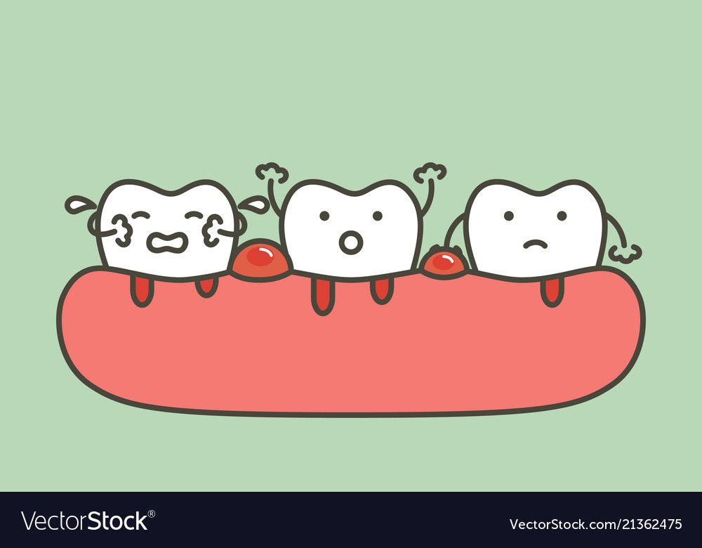 periodontitis or gum disease with bleeding vector 21362475