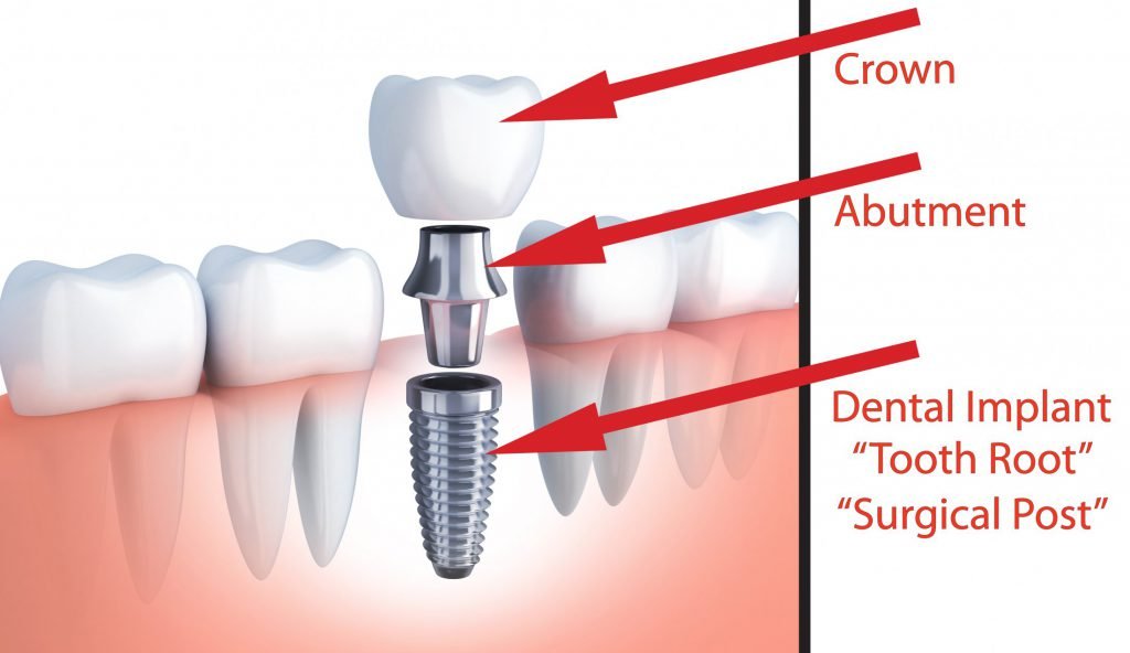 3 part implant 1 1024x592