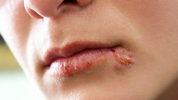 Cold Sores Symptoms Diagnosis 722x406