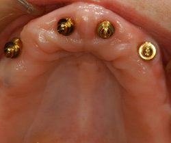 Implant snap denture 2 upper jaw 300x209