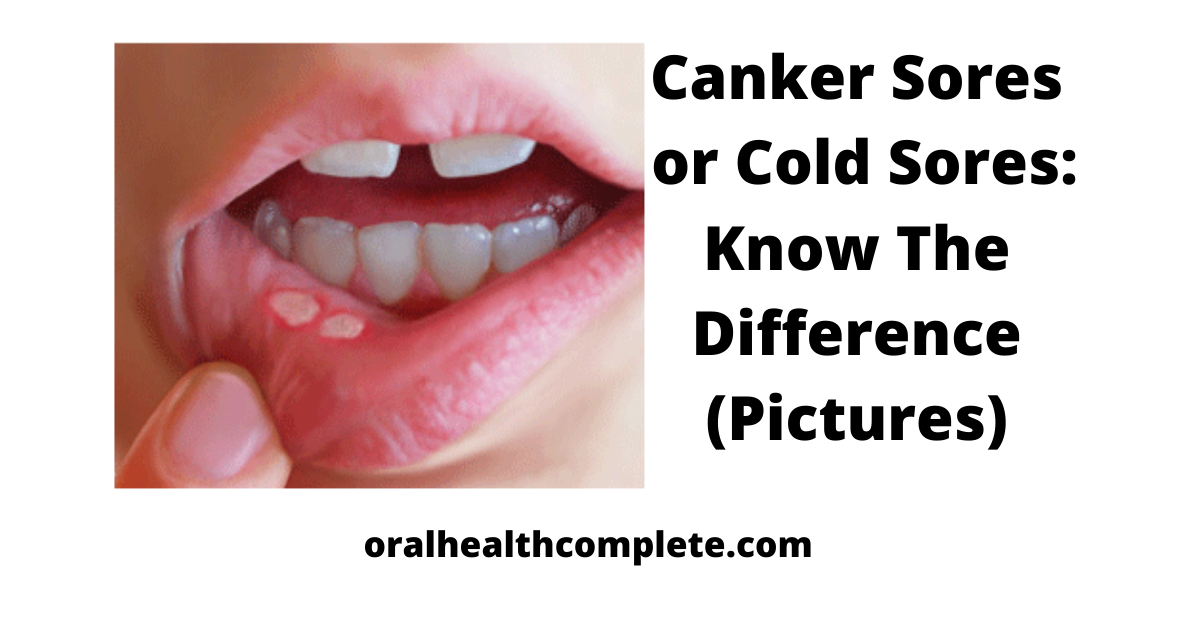 Tooth discoloration after trauma Reasons Treatments 13