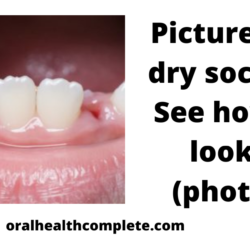 Tooth discoloration after trauma Reasons Treatments 2
