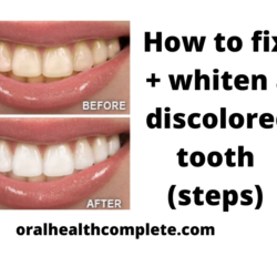 Tooth discoloration after trauma Reasons Treatments 20