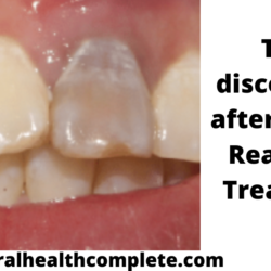 Tooth discoloration after trauma Reasons Treatments