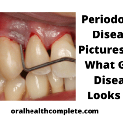 Tooth discoloration after trauma Reasons Treatments 5