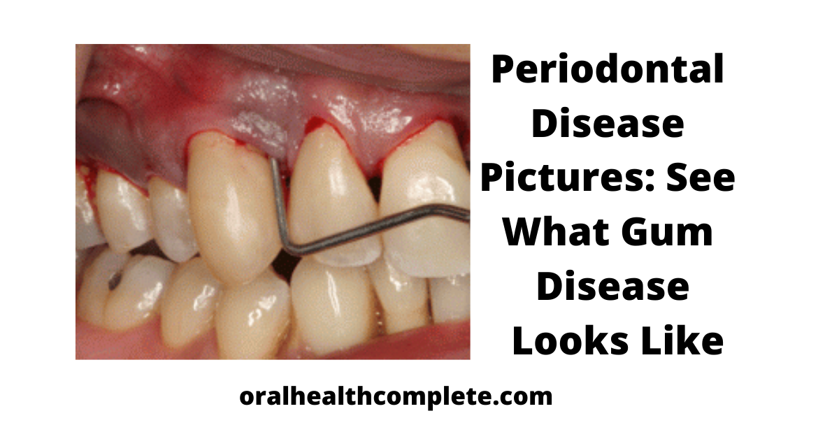 Tooth discoloration after trauma Reasons Treatments 5