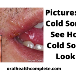 Tooth discoloration after trauma Reasons Treatments 9