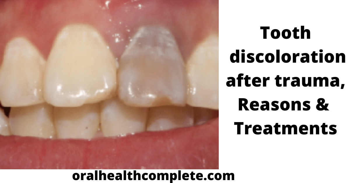 Tooth discoloration after trauma Reasons Treatments