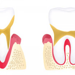 advanced periodontitis