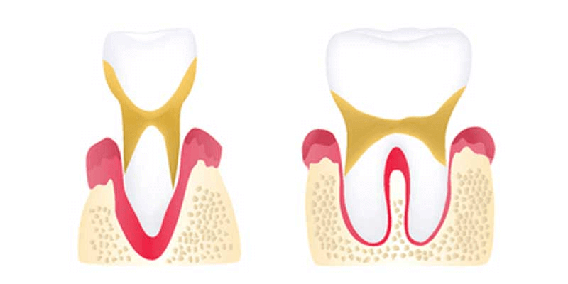 advanced periodontitis