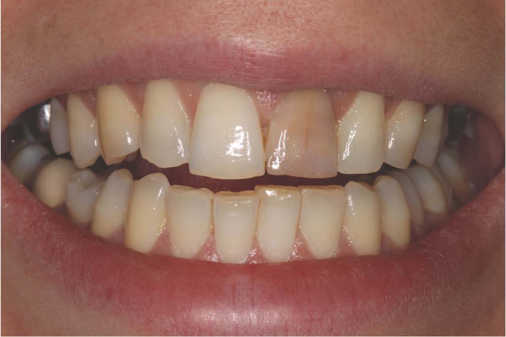 discoloured teeth