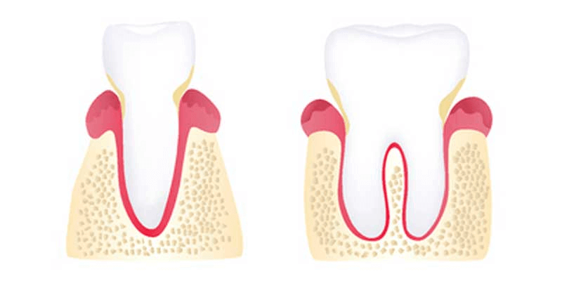 early periodontitis