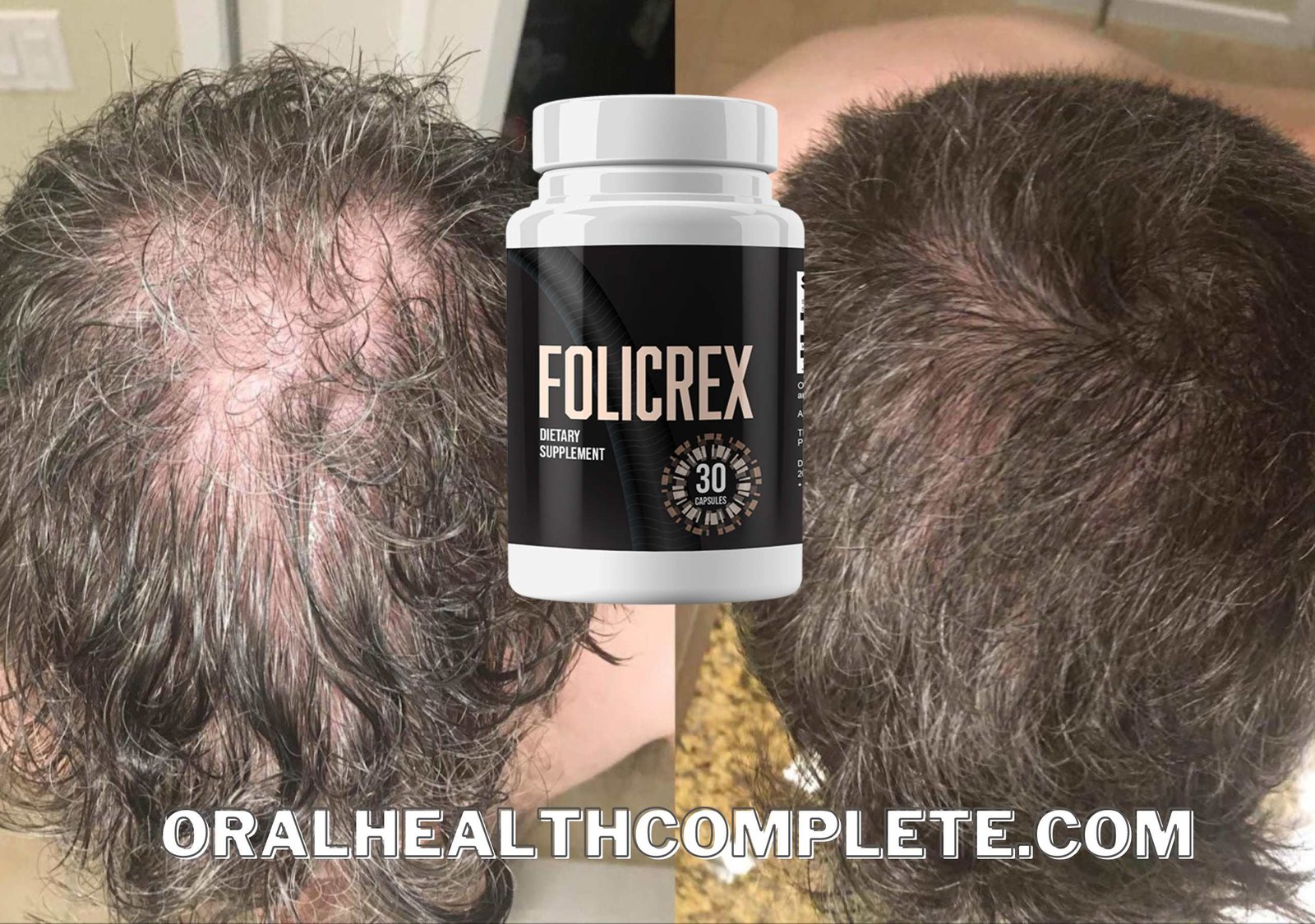 Folicrex reviews hair loss Supplement scam compressed